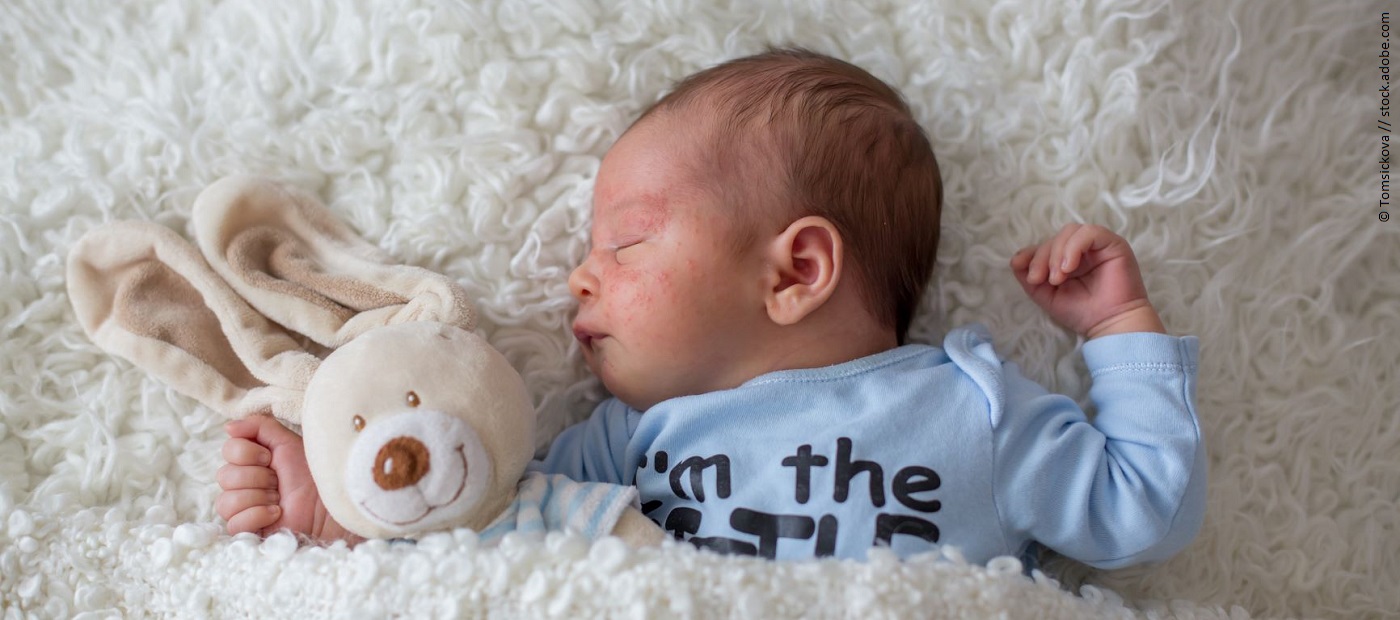 Ein Neugeborenes liegt mit einem Plüschhasen unter der Decke und schläft. Um das Auge herum sind rötungen und kleine Pocken zu sehen. 
